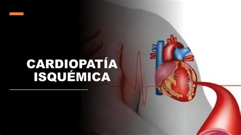 cardiopatía isquémica